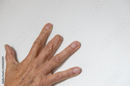 Man's right hand with amputated middle finger on a white background