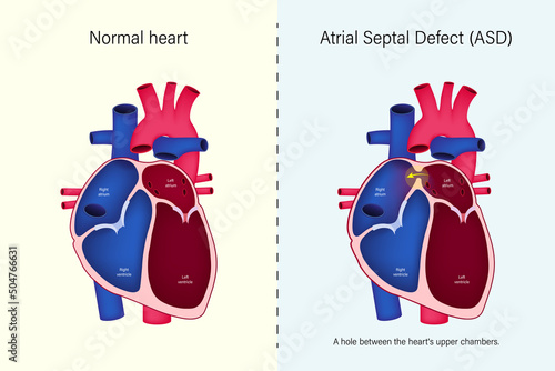 The difference of normal heart and atrial septal defect (ASD) vector. Congenital heart defect.