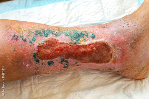 trophic ulcer of the skin in the lower leg in the granulation stage.