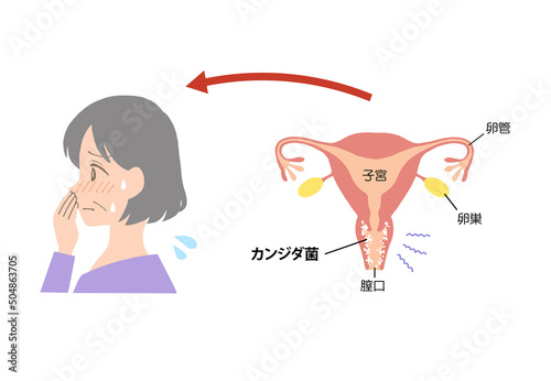 膣炎 病気になった子宮のイラスト