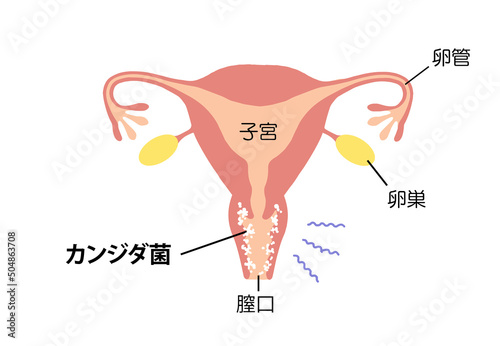 膣炎 病気になった子宮のイラスト