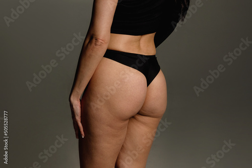 Buttocks and hips woman with cellulite and stretch marks close-up before liposuction procedure and cosmetic therapy