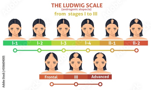 Ludwig scale of androgenic alopecia step poster