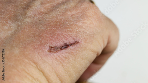 Close up of a red wound scab injury on the adult caucasian hand. lesion forming wrinkle makes itchy and scratch change to scar and take a long time to heal, healthcare concept