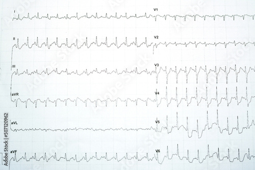 A positive stress induced myocardial ischemia with significant horizontal ST depression changes in the stress ECG ElectroCardioGram test, Patient was exercised according to Bruce protocol