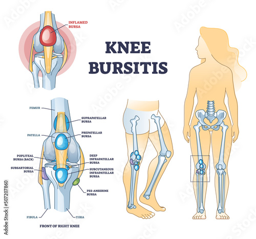 Knee bursitis condition with fluid filled bursa in leg joint outline diagram. Labeled educational medical liquid growth anatomy scheme with chronic leg inflammation pathology vector illustration.