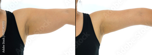 Comparison before and after Obesity Cellulite And Fat Removal liposuction Surgery on upper arm to get rid of sagging fat arm skin. Brachioplasty or Upper-Arm Lift plastic surgery in Asian woman. 
