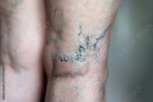 Close up of female leg with extensive varicosity on popliteal region