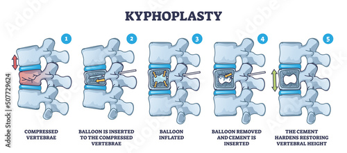 Kyphoplasty invasive surgery for spinal compression fracture treatment outline diagram. Labeled educational medical procedure for vertebrae reconstruction with balloon and cement vector illustration.