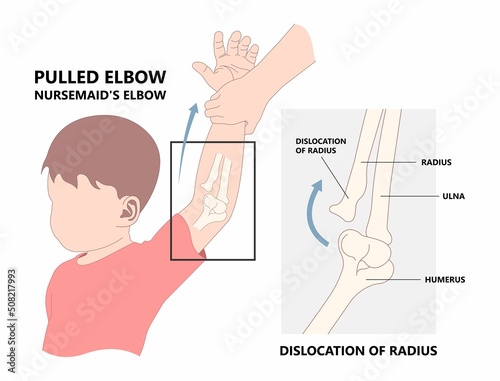 Child elbow dislocated injury that cause ulna bone fracture nursemaid painful head of radius subluxation young slight bend