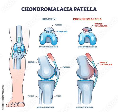 Chondromalacia patella knee breakdown compared with healthy outline diagram. Labeled educational kneecap tissue damage with cartilage problem and anatomical leg joint structure vector illustration.