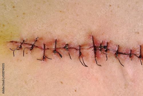Medical sutures, stitches after surgery, stitched surgical sutures on human body. Medical surgical care.