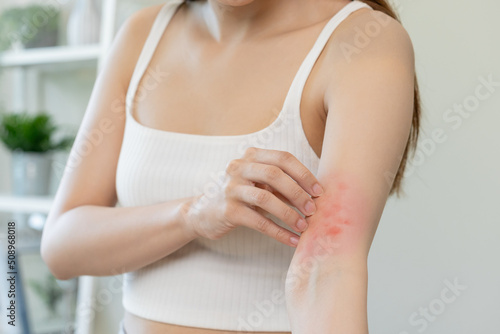 Dermatology asian young woman, girl allergy, allergic reaction from atopic, insect bites on her arm, hand in scratching itchy, itch red spot or rash of skin. Healthcare, treatment of beauty.