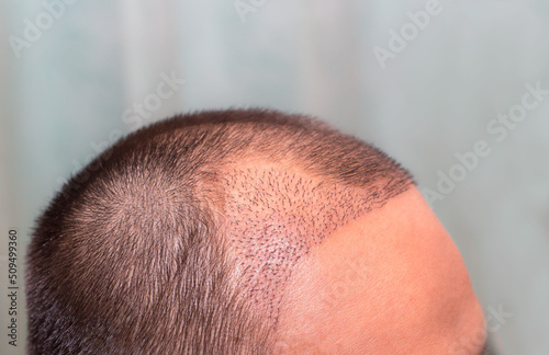 Top view of a man's head with hair transplant surgery with a receding hair line. - After Bald head of hair loss treatment.