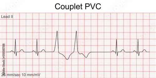 Electrocardiogram show Couplet Premature Ventricular Contraction (PVC) pattern ,Heart beat ,ECG ,EKG interpretation ,Vital sign ,Life line ,Medical healthcare symbol.