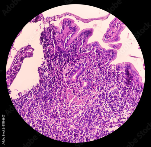 Terminal ileum(biopsy): Chronic nonspecific ileitis or inflammation of ileum, show ileal mucosa, lymphocytes,histiocytes,plasma cell, caused by Crohn's disease, inflammatory bowel disease (IBD).