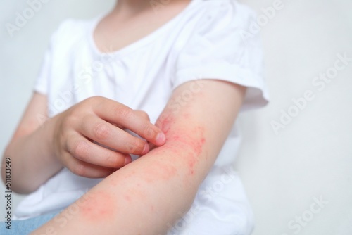 The child scratches atopic skin. The child applies a special cream to atopic skin. Dermatitis, diathesis, allergy on the child's body. 