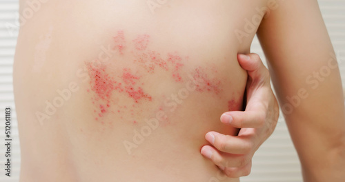 man with shingles disease