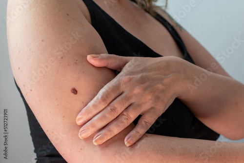 a womans arm with an abnormal mole that was diagnosed as being malignant melanoma skin cancer