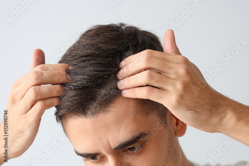 Young man with problem of dandruff on light background, closeup