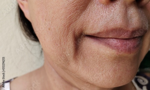 close up portrait showing the flabbiness adipose hanging beside the mouth, problem wrinkles and dark spots on the face of the woman, concept health care.