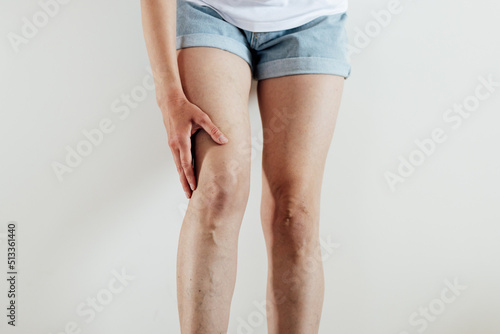 Woman with tired painful and spider varicose veins isolated on beige background. Healthcare problem, thrombophlebitis issue. laser surgery recovery and prevention, Compression Stockings Thigh