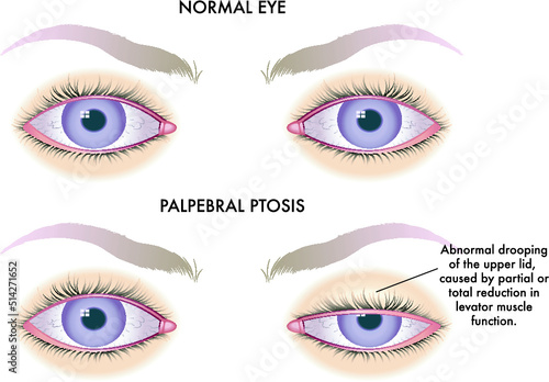 Medical illustration shows the comparison between a normal eye and one affected by palpebral ptosis.
