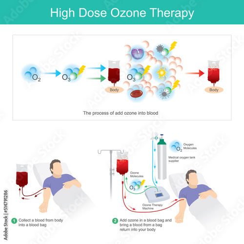 High Dose Ozone Therapy. This process add ozone in a blood bag and bring a blood from a bag return into your body..