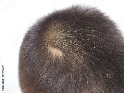 Scar on skin head in kid boy use for fue hair transplant concept. 
