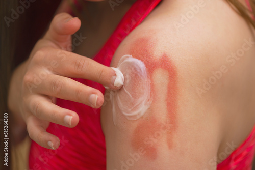  Sunburn,Allergic reaction, itching, allergy, dermatitis. Close-up of a woman applying cream or ointment to swollen skin after a mosquito bite, isolated on a grey studio background.