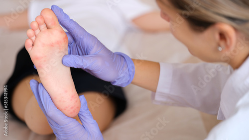 Doctor examining foot of child with red itchy rashes in clinic closeup
