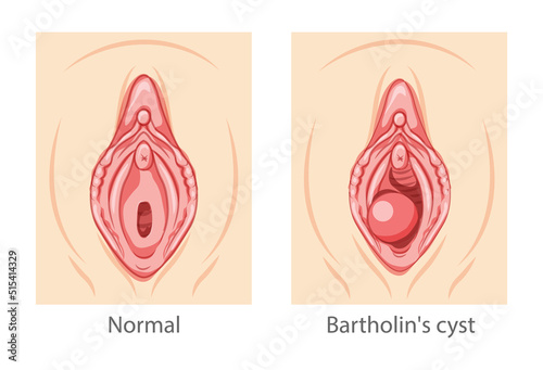 Bartholin's cyst gland Female reproductive system uterus. Female Sick vs normal organs. Human Surface anatomy of perineum external organs location scheme, vagina pain vulva blockage flat style icon