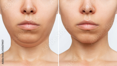 Liposuction of the double chin. Cropped shot of a woman's face with chin before and after cosmetic plastic surgery isolated on a white background. The result of lifting, fat removal, weight loss