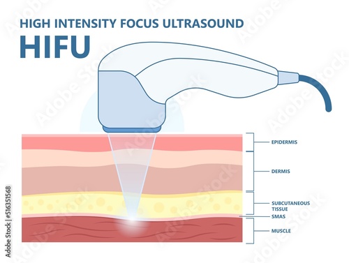 Anatomy of skin cell after the HIFU therapy or High Intensity Focus Ultrasound face saggy treat body lift laser hair firm tightening brow toxin droopy double chin scar