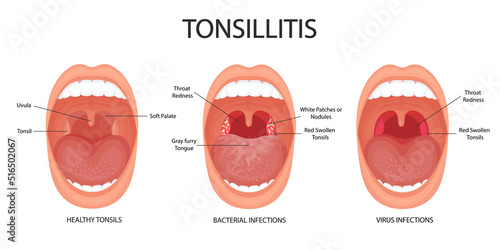 Angina, pharyngitis and tonsillitis. Tonsillitis bacterial and viral. Tonsil infection. Open mouth, anatomy. 