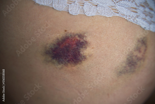 Close up of a hematoma on buttock after fall. A minor injury after sport activity appearing as a swollen area of discolored skin on the body