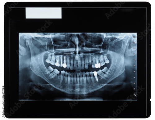 orthopantomograph panoramic image radiograph of teeth