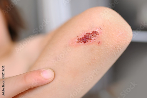 healing wound on child's hand, crusted abrasion in elbow area, scar, traumatic safety concept for children, treatment of injuries, medical care, health risk, bacterial contamination of the abrasion