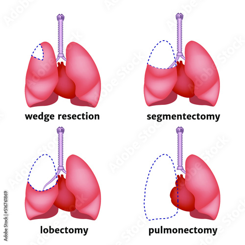 Types of lung resection. Removal of an organ or its individual parts in case of cancer. Medical poster. Vector illustration.