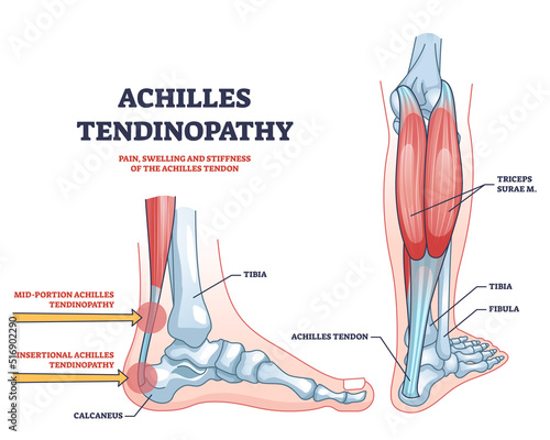 Achilles tendinopathy as injury to tendon in heel outline diagram. Labeled educational scheme with anatomical leg and foot skeleton and muscles vector illustration.Trauma and band of tissue problem.