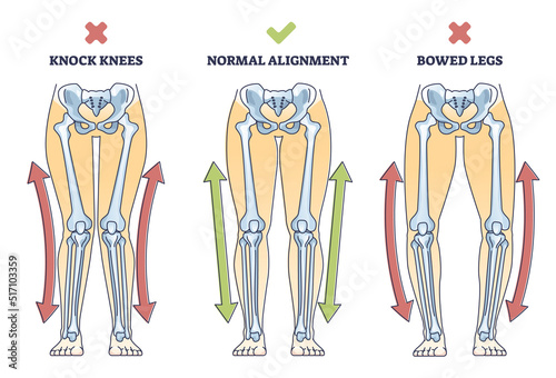Bowed legs syndrome with normal and knock legs comparison outline diagram. Labeled educational physical defect with outward bending and knees does not touch vector illustration. Anatomical explanation