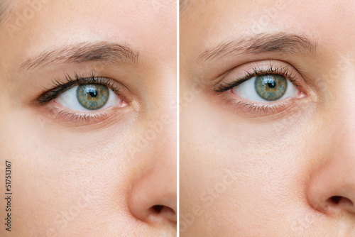 Close up of a young caucasian woman's face with drooping upper eyelid before and after blepharoplasty isolated on white background. Result of plastic surgery. Changing the shape, cut of the eyes