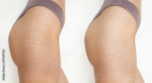 stretch marks before and after Hips after stretch mark removal treatment