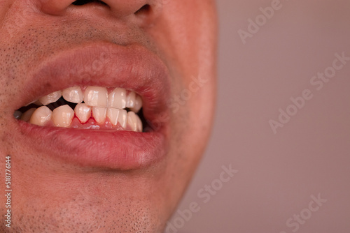 Close up of woman mouth with bleeding gums during teeth brushing. Periodontal disease, avitaminosis, gingivitis, scurvy