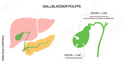 Gallbladder polyp anatomy