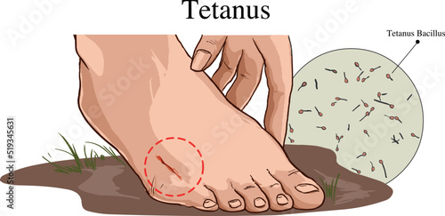 Damage to the feet. the risk of tetanus