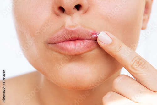 Herpes on the lip. Young woman smears the blisters caused by virus on the mouth with ointment isolated on a white background. Itching and redness on the girl's face. Treatment of herpes