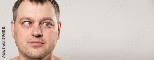 A man with strabismus squints his eyes on a white background, a banner with space for text.