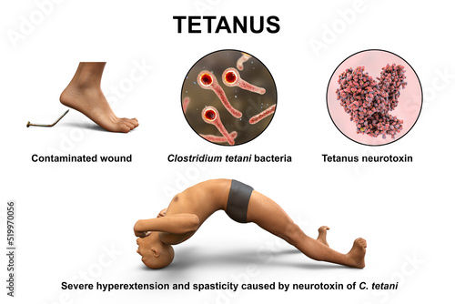 Tetanus disease, opisthotonus in a man suffering from tetanus