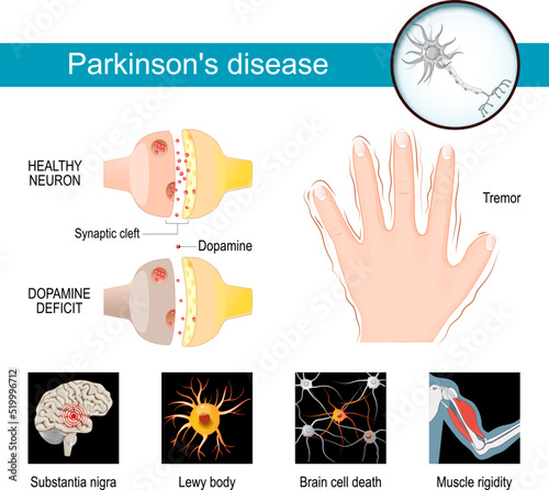 Parkinson's disease Infographic. Symptoms of a parkinsonism.